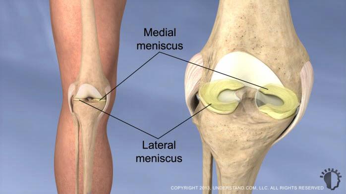 A torn meniscus generally results from forcefully twisting or pivoting the knee with the foot planted, such as occurs during certain sports.