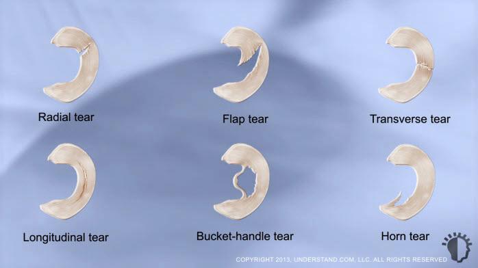 Meniscal Tears & Treatment Options Meniscal tears occur in a variety of patterns and may worsen with time.
