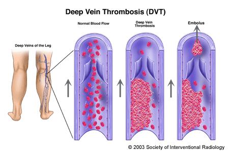 Deep Vein Thrombosis (DVT) Deep Vein Thrombosis (DVT) is the formation of a blood clot, known as a thrombus, in the deep leg vein.