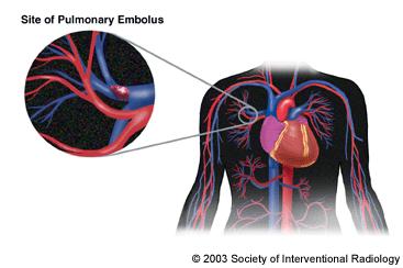 The symptoms are frequently nonspecific and can mimic many other cardiopulmonary events.