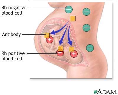 Rh Incompatibility The mother s body can recognize the Rh positive factor in the baby s blood as foreign and it can stimulate an antibody response in the mother.