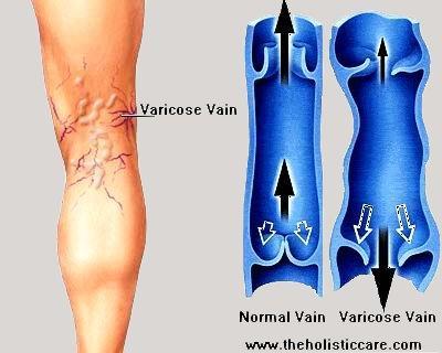 Interesting Note: Varicose Veins Portions of the veins lose elasticity and become extended, preventing their valves from closing