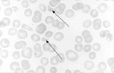 E. coli O157:H7, Complications Causes Haemorrhagic colitis (HC) and haemolytic uraemic syndrome (HUS) in humans Sometimes causes Trombotic trombocytopenic purpura