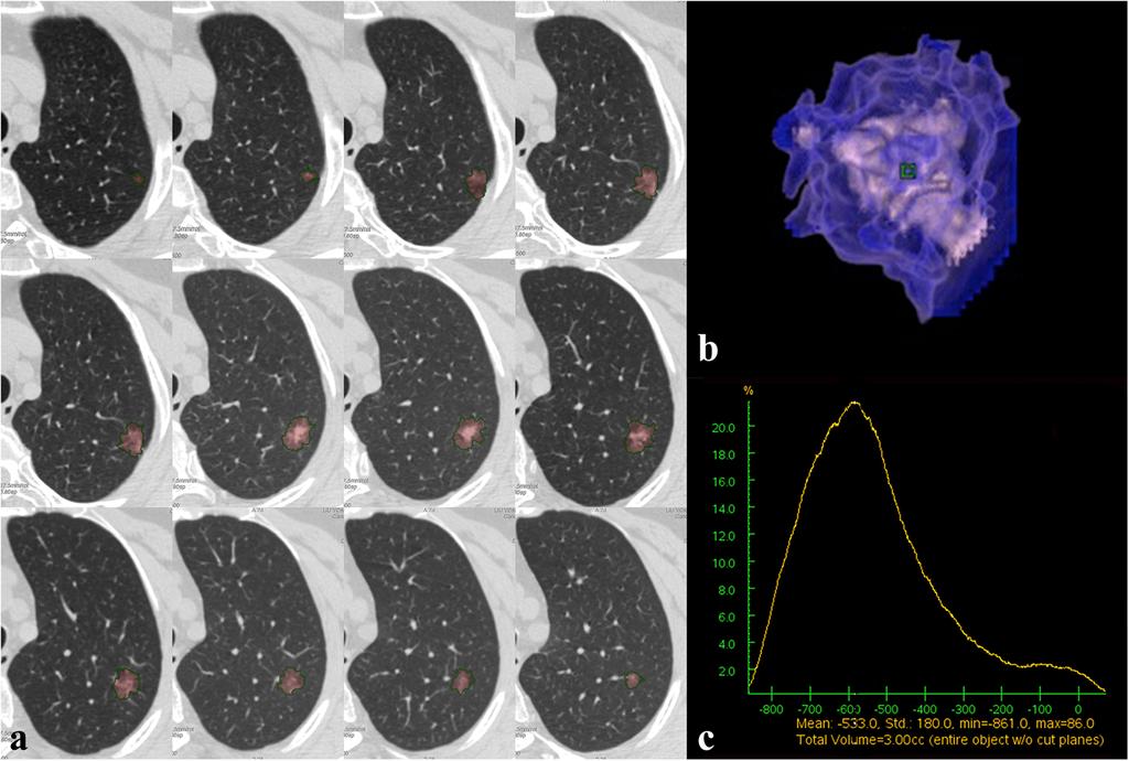 Li et al. Cancer Imaging (2018) 18:18 ROI was drawn in a presumed nodular location, considering the CT component images of PET/CT.