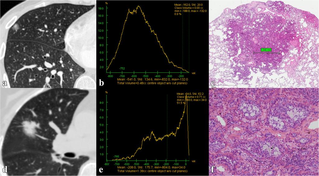Li et al. Cancer Imaging (2018) 18:18 Page 7 of 10 Fig. 3 Images in a 46-year-old patient with minimally invasive adenocarcinoma (a~c) and a 72-year-old patient with invasive adenocarcinoma (d~f).