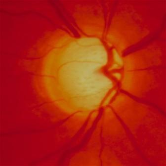 Uveitic Glaucoma Angle changes Aqueous