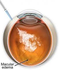 Periocular and Intravitreal Cor/costeroids Injections