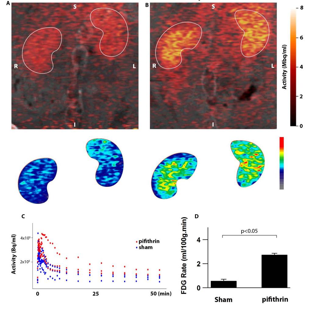 Positron Emission Tomography (PET) Frequently used clinically to detect neoplastic tumors based on preferential uptake of glucose (Warburg effect) 2-18 F deoxyglucose