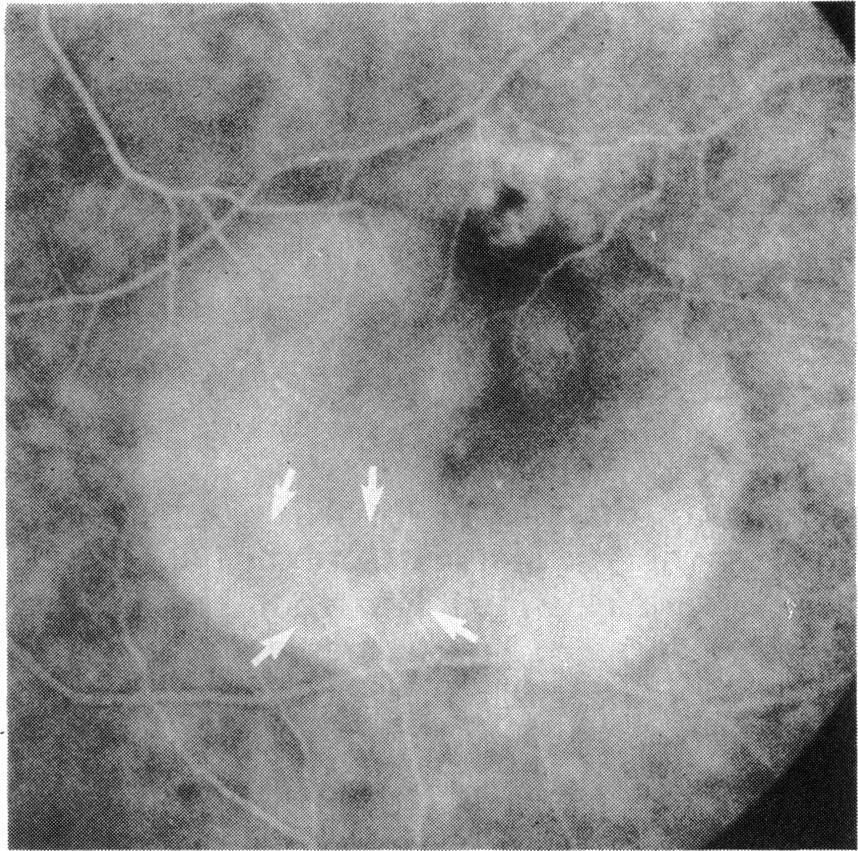 The criteria for the diagnosis of a PED was elevation of the retinal pigment epithelium with accumulation of fluorescein dye in the subpigment epithelial space during angiography.