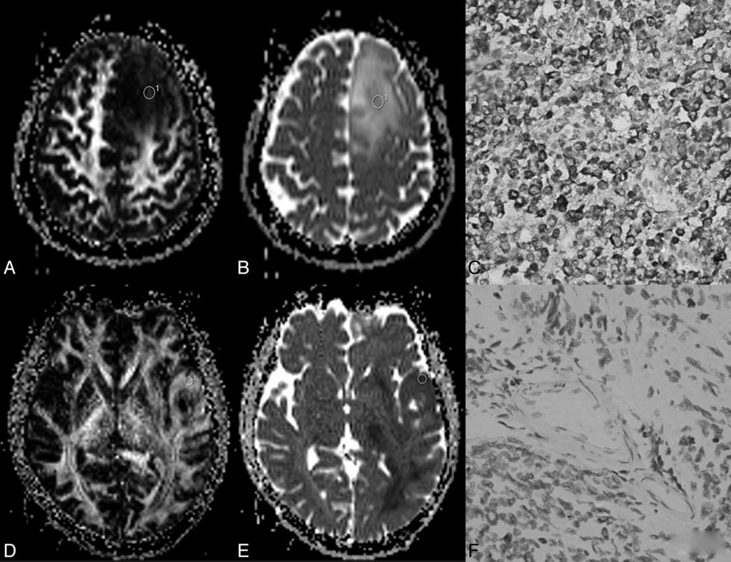 FIG 4. A C, A 35-year-old woman with a grade III anaplastic astrocytoma and IDH1 R132H antibody examination expressed positively.