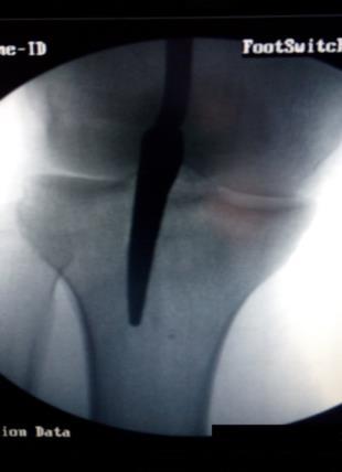 Among the various modalities of treatment such as conservative gentle manipulation and use of long leg cast with a window, open reduction and internal fixation with plates and screws, intramedullary