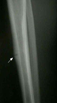 Anterior cortex of tibia Bad stress fracture High rate of non-union Tensile side of the tibia Can