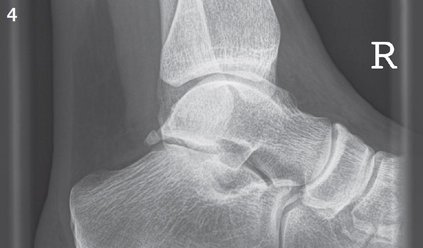 Posterior ankle pain 21 yr old dancer with posterior ankle pain Achilles tendinitis for years.