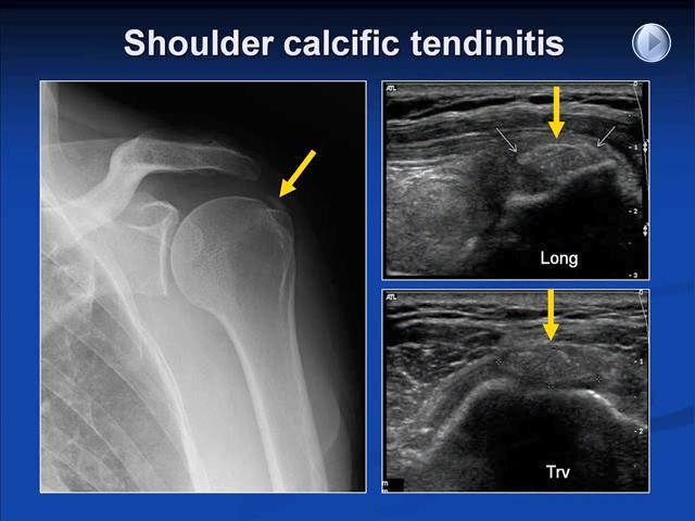 Calcific Tendinitis: Rotator Cuff Acute on chronic shoulder pain Examination findings c/w impingement MRI not