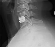 , J Neurosurg Spine 2007: SUMMARY OF DATA PRESTIGE ARTHROPLASTY GROUP was SUPERIOR in: NEUROLOGIC SUCCESS (motor/sensory function) BETTER NECK DISABILITY INDEX SCORES LOWER VAS SCORES FOR NECK PAIN