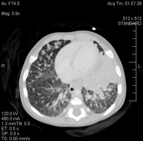 day 8): additional imaging studies obtained CT of neck, chest, abdomen, head CT