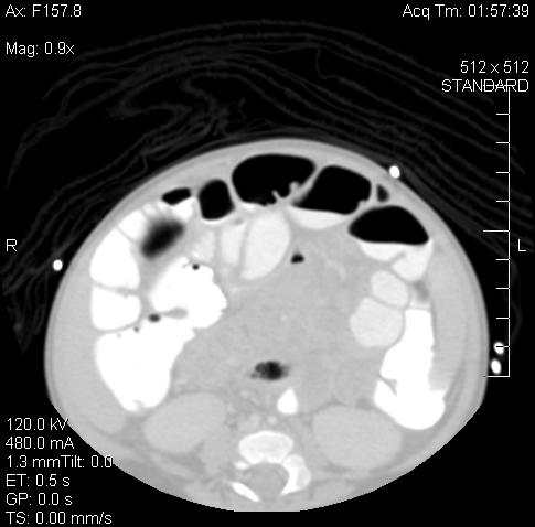 infiltration CT chest (Jan 13 th ): multiple pulmonary lesions with large mass