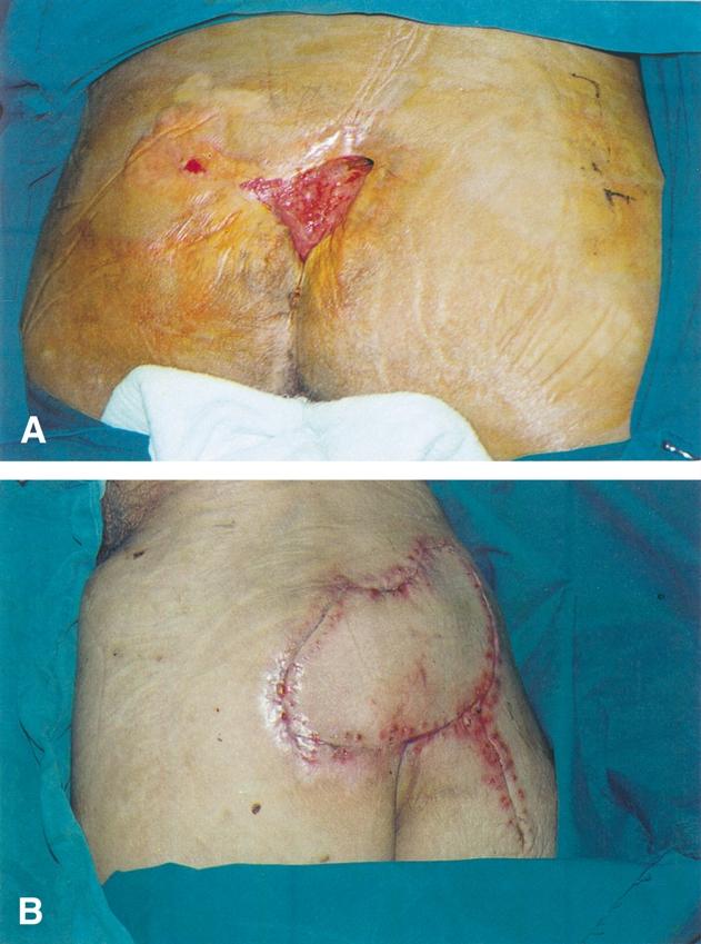 The gluteal perforator-based flap in repair of pressure sores 345 Figure 4 A 90-year-old female patient. (A) Pre-operative view of the pressure sore. (B) Gluteal perforatorbased transposition flap.
