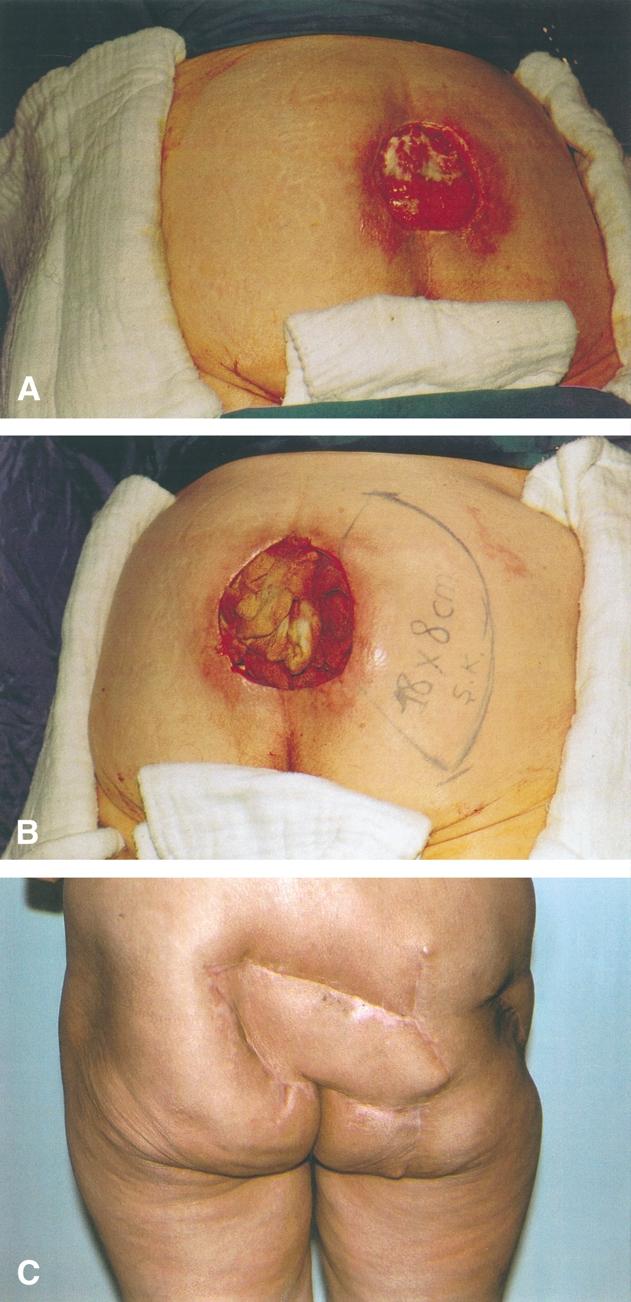 4%) cases (patients no: 11, 16 in Table 1), which were repaired with rotation flaps. In four (14.8%) patients distal epidermolysis of the flap was seen which improved spontaneously.
