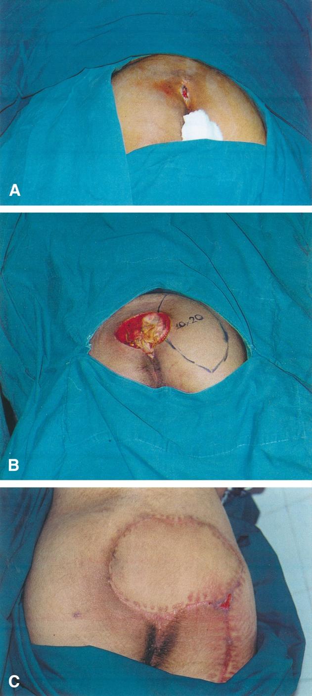 346 Ç. Meltem et al.ç. Meltem et al. he fell from a height. A sacral pressure sore was closed with a 10 20 cm 2 gluteal perforator-based rotation flap (Fig. 6(A) and (B)).