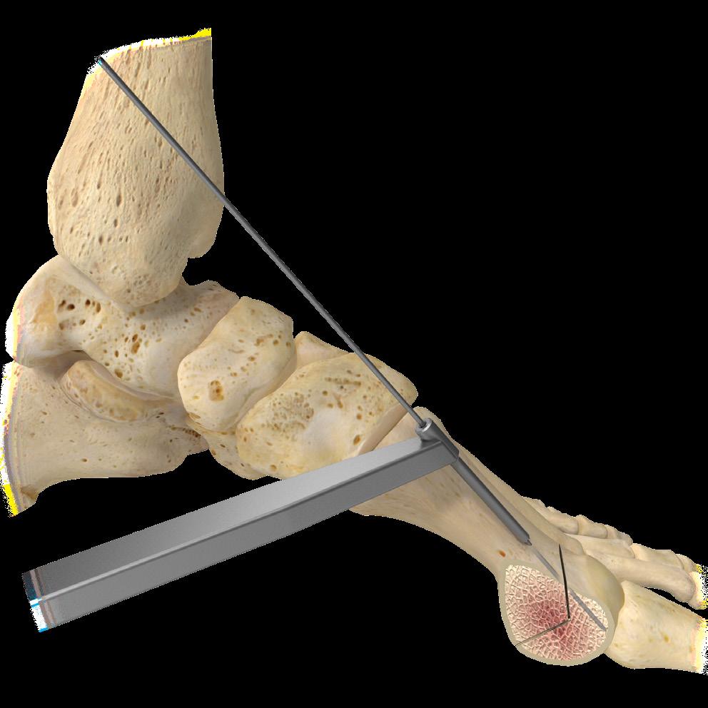 4 3.0 mm Cannulated Screw System Surgical Technique Figure 1 Figure 2 The following surgical technique describes the use of a 3.0 mm cannulated screw for a distal osteotomy of the first metatarsal.