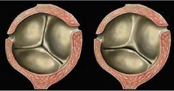 Figure 2: Example of a normal tri leaflet (left) and bicuspid aortic valve (right) Figure 1: Macroscopic appearence of stenotic aortic valve symptoms predicts a poor prognosis; the approximate time