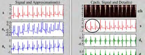 The peaks of QRS complexes flatten; P and T waves containing lower frequencies become more visible [2].
