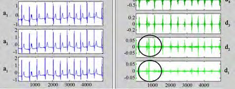 ECG signal, d1 to d5 decomposition coefficients are shown on the right hand side of the Figure 17.