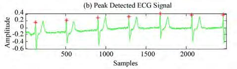 From these figures it is clearly seen that PPT detects the R peaks when the noise level or the artifacts in ECG is more.