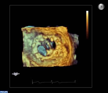 Baseline Mitral Valve and 3D Color AO LAA Medial Medial