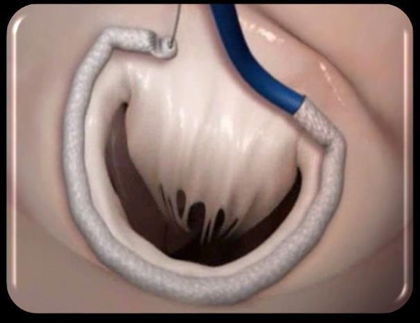 Arterial access Subannular cinching