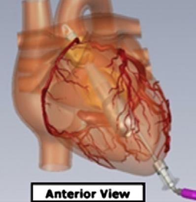Mechanical Circulatory Support New VADs HeartAssist 5 HeartMate III HeartMate X Miniature