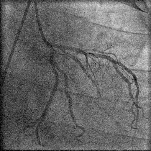 Primary PCI for Acute MI 54 year old