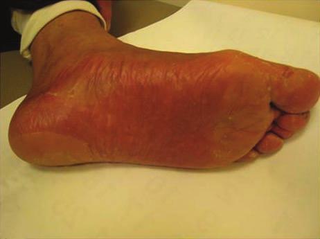 weeks). The patient was treated with MEBO. (D) After management, Grade 2 HFS; Painless erythema / discomfort, able to perform daily living activities.