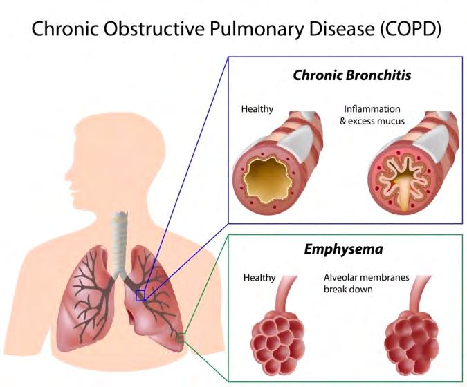 Clinical Research Xiao Qing Long Tang 小青龍湯 Bronchial Asthma COPD