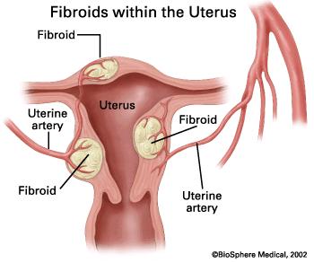 Gui Zhi Fu Ling Wan 桂枝茯苓丸 Infer>lity Uterine fibroids