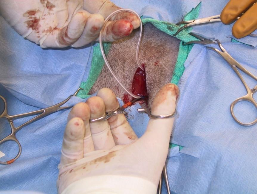 Abdominal end is pushed into abdomen using Kelly hemostats Extra
