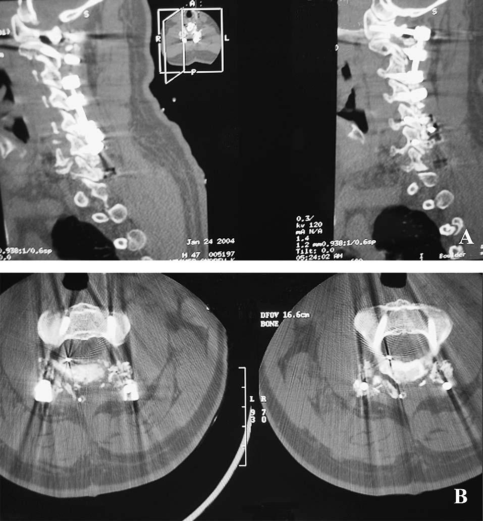 Biplanar fluoroscopy exposure time and operative time were assessed for transforaminal lumbar interbody fusion (TLIF) and kyphoplasty procedures.
