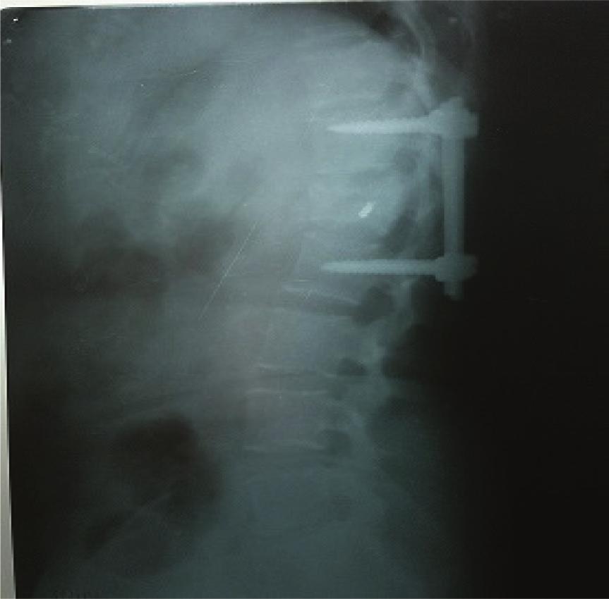 post-operative X-ray Figure 4 : 1