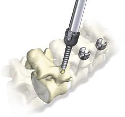 prepare the pedicle screw canal. The tap sizes are 4.5mm/