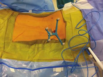 In this paper, we describe our perioperative MIS technique for placing percutaneous spinal instrumentation utilizing the O-arm with navigation. 2. Surgical Technique and Pearls 2.1.
