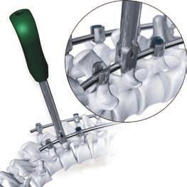 Rod Manipulator Allows the surgeon to move the rod mediallateral of cephalad-caudal.