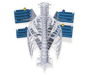 Step 4: 3-Dimensional scoliosis correction is