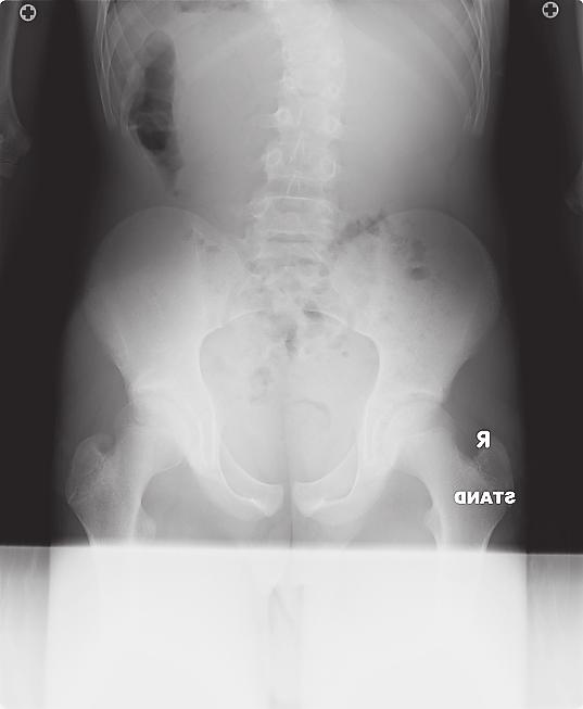 Spinal correction surgery was planned because the kyphoscoliosis of the patient was both severe and progressive, with the possibility of deteriorating to paralysis.