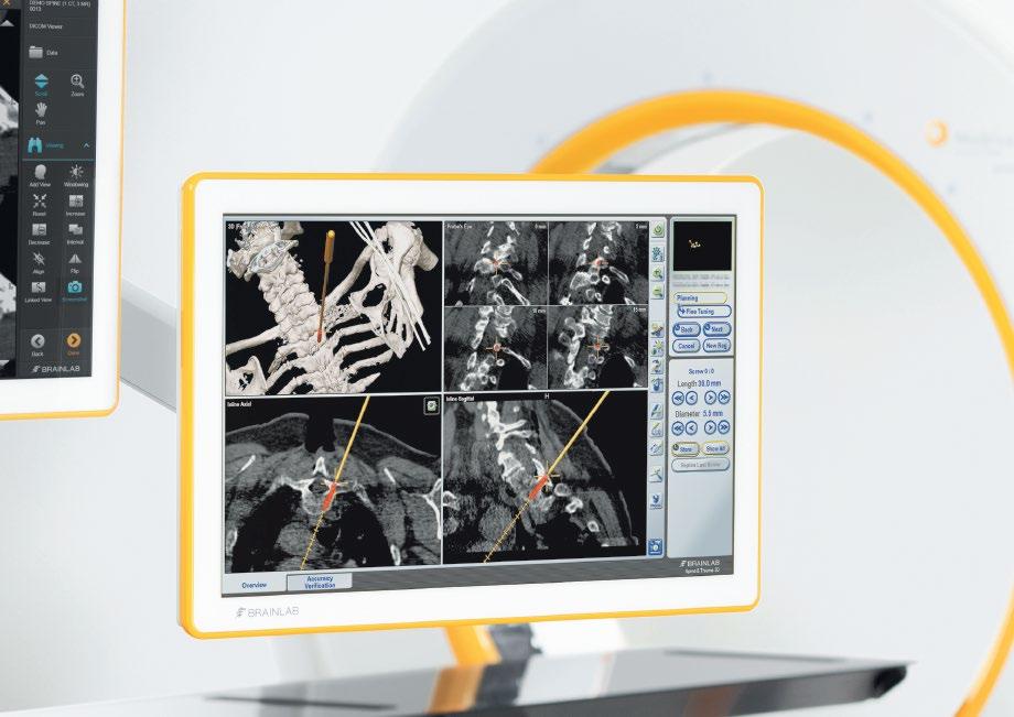 With Airo Mobile Intraoperative CT and Automatic Image Registration scans are registered and