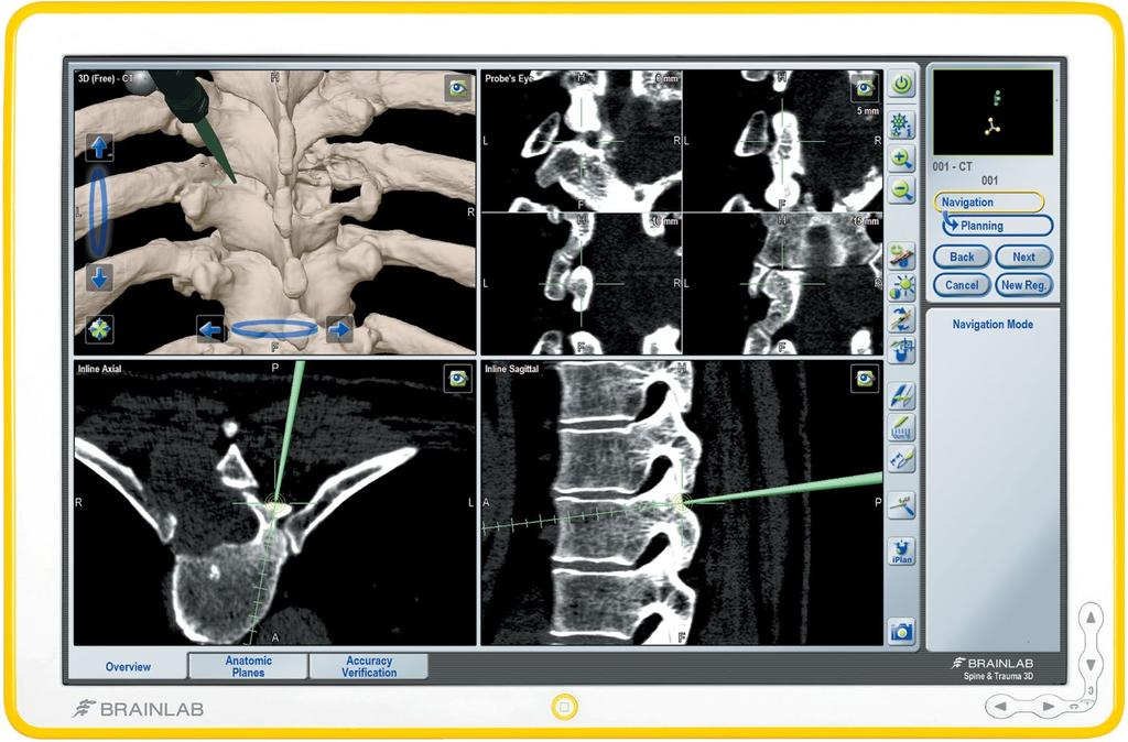 As an open navigation platform, Brainlab Spinal Navigation enables accurate pedicle screw placement as well as drastic reduction of X-Ray exposure to both the surgical team and the