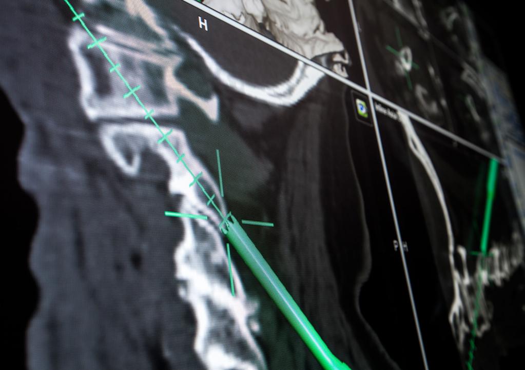 Brainlab Spinal Navigation assists in the safe placement of implants, especially in anatomically critical areas.