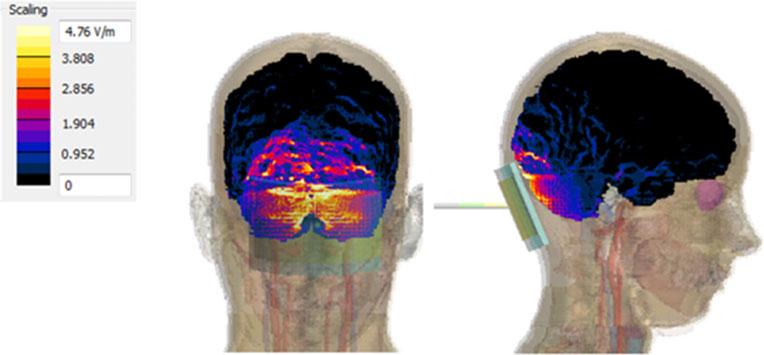 Fig. 4 This preliminary modelling study shows that the active electrode over the cerebellum with an extra-cephalic reference generates the maximum electric field density in the cerebellum.