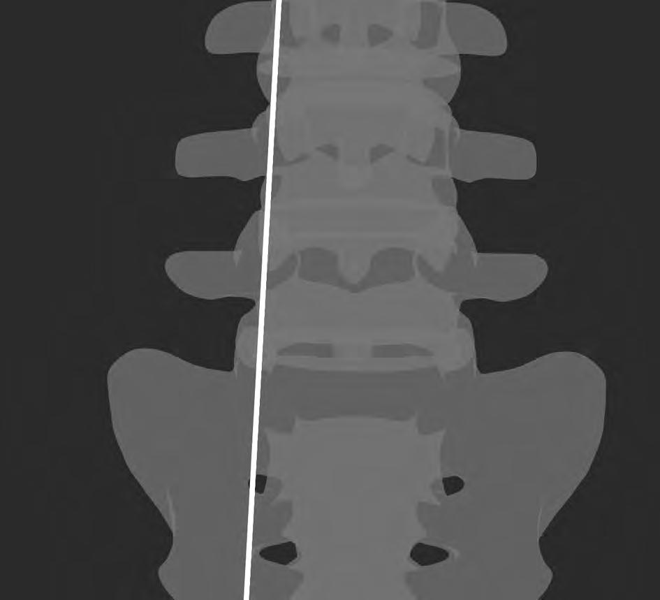 the lateral pedicle wall of the targeted level AND adjacent