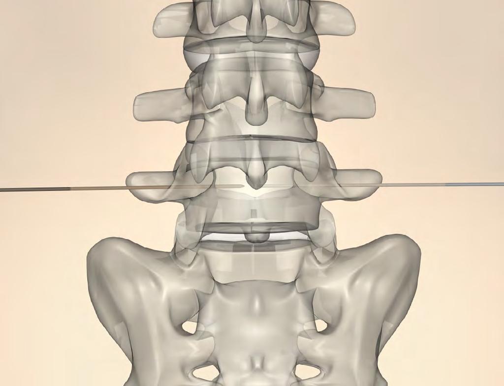 anterior cortex of the vertebral body into the patient s abdomen.